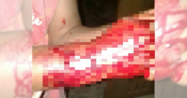 CRIANÇA DE 9 ANOS É ATACADA POR PIT BULL EM CATALÃO
