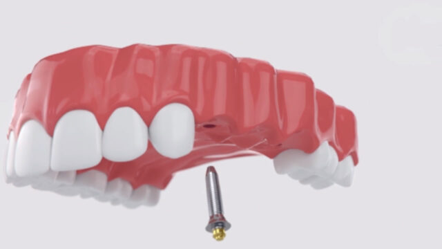 Dicas de Saúde Bucal com a Drª Mariah - Implantes Dentários