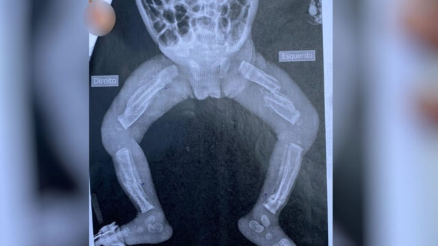 Bebê que sofreu várias fraturas e queimaduras morre em hospital de Goiânia; pais estão presos