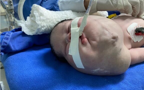 Mãe de bebê que tem tumor no pescoço maior que a cabeça pede ajuda para comprar remédio para a filha, em Goiás
