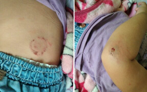 Mulher é suspeita de morder a própria filha de 1 ano, em Goiânia
