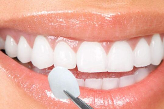 Lentes de Contato Dental: a queridinha do momento
