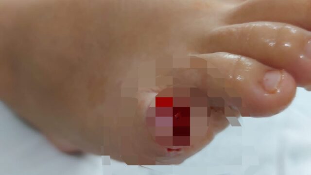 Criança tem dedo do pé arrancado por piranha em lago de Buriti Alegre