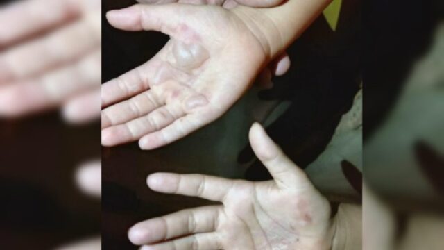 Mãe é suspeita de queimar as mãos das filhas como castigo após as crianças comerem uma lata de leite condensado, em Rio Verde