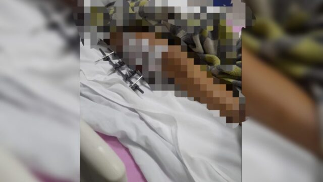 Família de menina que sofreu acidente na GO-330 em Catalão pede ajuda
