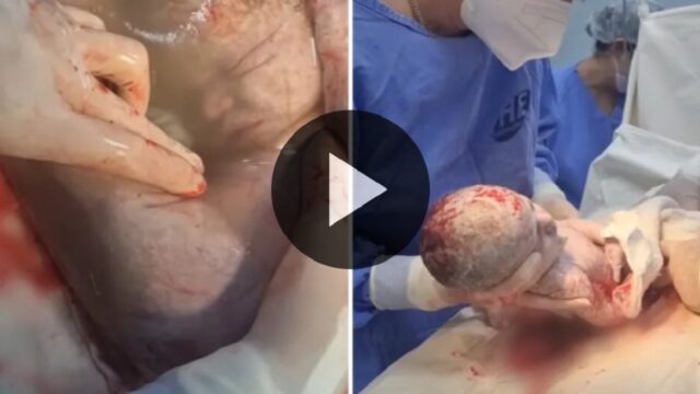 Em parto raro, bebê nasce empelicado em Iporá; vídeo