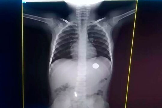 Escola de Uberlândia vai indenizar adolescente que engoliu moeda e teve que esperar aula acabar para ir ao médico