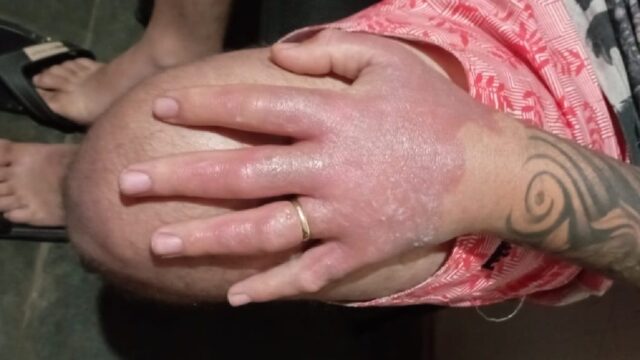 Homem sofre queimadura de segundo grau na mão após manusear limão no sol em, Araguari