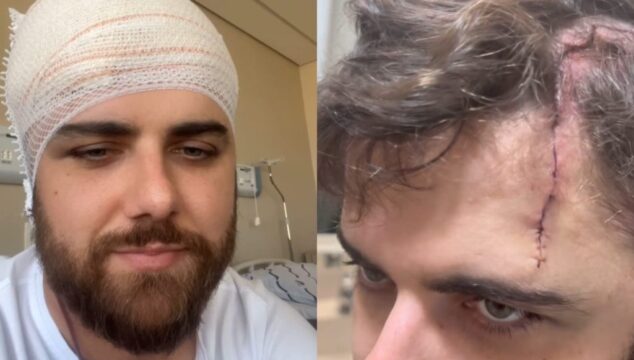 Zé Neto compartilha vídeo mostrando grave ferimento na cabeça após acidente de quadriciclo; cantor precisou passar por sutura com 54 pontos