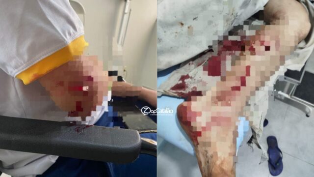 Ataque brutal de pitbulls deixa duas pessoas gravemente feridas em Catalão; polícia apura o caso