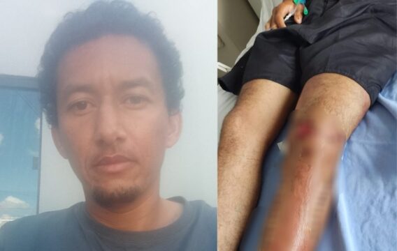 Familiares e amigos fazem vaquinha em Catalão para ajudar homem que precisa de enxerto de pele após acidente grave