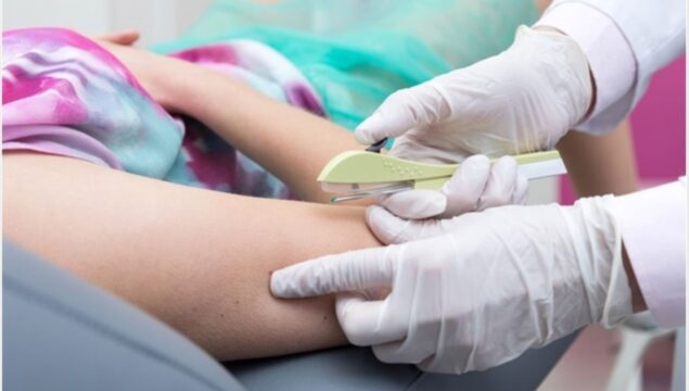 Prefeitura de Catalão inicia oferta do implante contraceptivo Implanon na rede pública de saúde; método tem eficácia superior a 99% e duração de até três anos