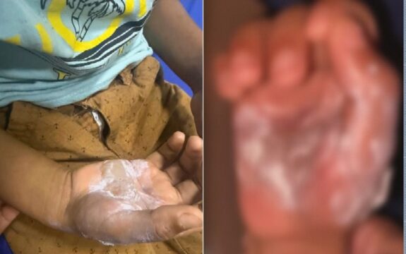 Mãe é presa suspeita de queimar filho de sete anos com colher, em Goiás